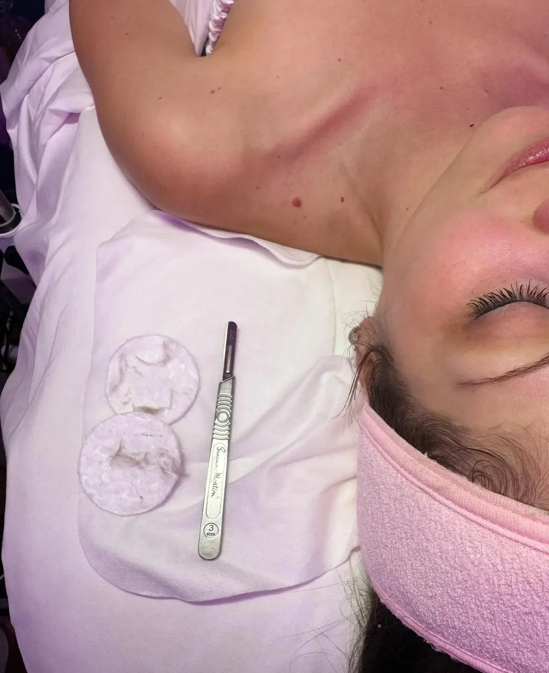 The Truth About Dermaplaning: Is It Really Worth the Hype?